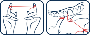 How to use thread waxed flowing with microRepair®